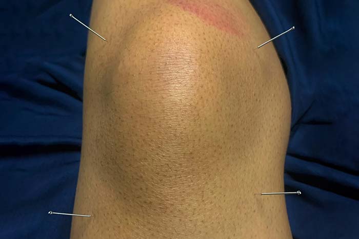 Dry Needling