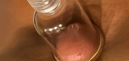Vacuum_Cupping.jpeg