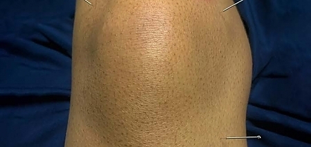 dry-needling